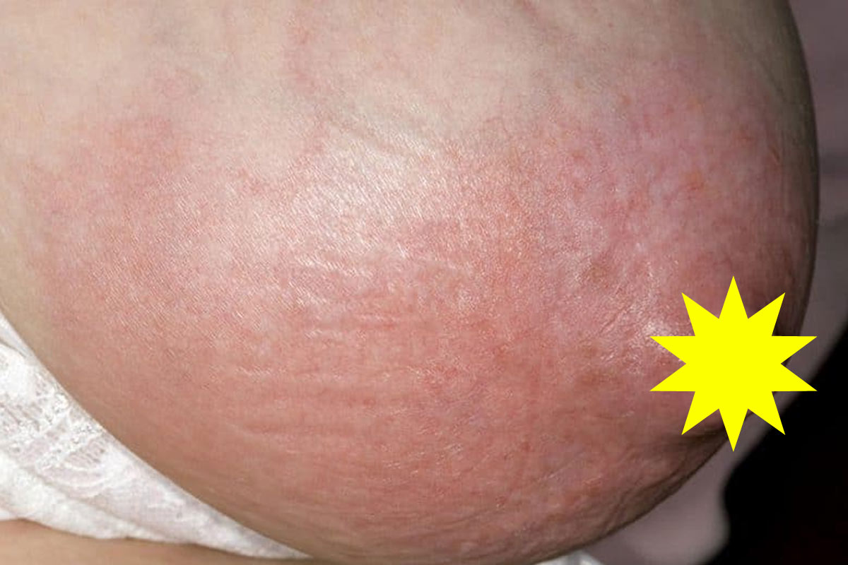 engorgement breastfeeding